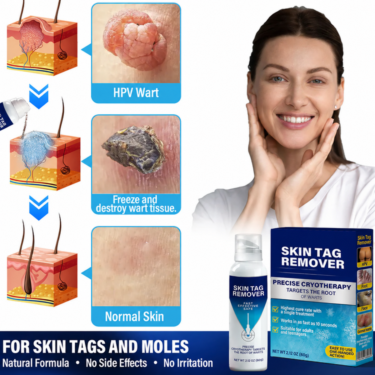 Cryo Treatment Spray for Skin Tags & Warts