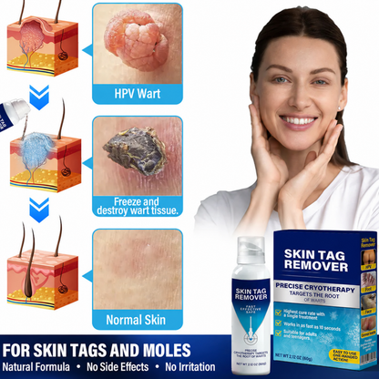Cryo Treatment Spray for Skin Tags & Warts