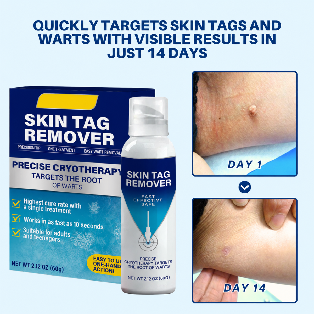 Cryo Treatment Spray for Skin Tags & Warts